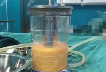 桐乡360度水动力吸脂费用多少钱？