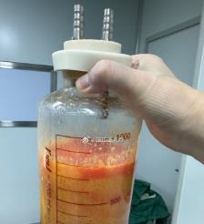 桐乡水动力吸脂手术要做多久？